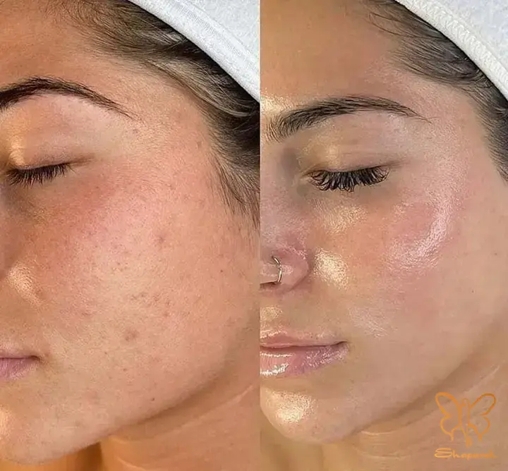 نکات کلیدی برای جلوگیری از عفونت و لک بعد نیدلینگ در مشهد نکات کلیدی برای جلوگیری از عفونت و لک بعد نیدلینگ در مشهد