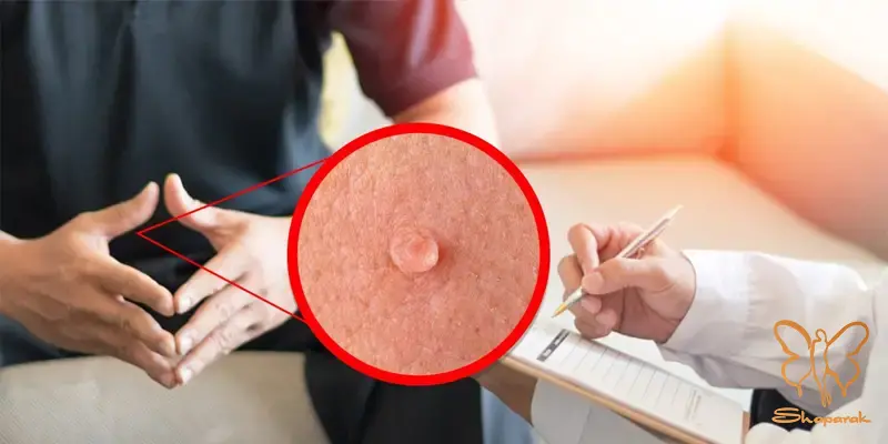 بررسی عوامل ایجاد و نحوه انتقال زگیل تناسلی بررسی عوامل ایجاد و نحوه انتقال زگیل تناسلی