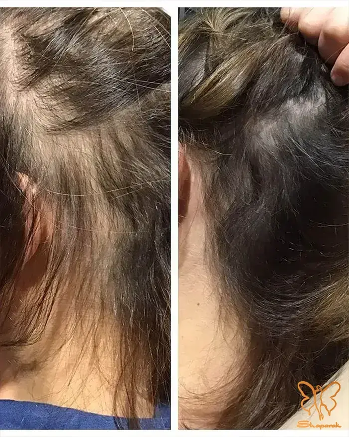 هیالورونیک اسید هیالورونیک اسید