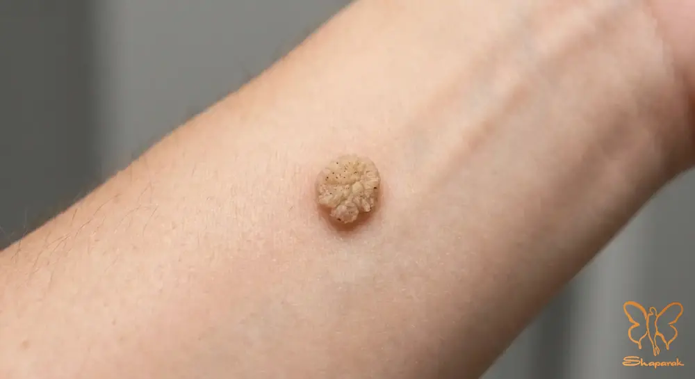 HPV 