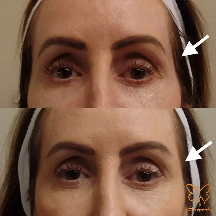 راز جوانی چهره با تزریق فیلر شقیقه در کلینیک شاپرک طلایی مشهد راز جوانی چهره با تزریق فیلر شقیقه در کلینیک شاپرک طلایی مشهد