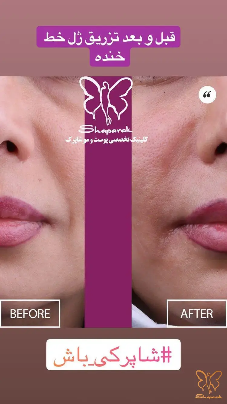 تزریق فیلر خط خنده در شاپرک طلایی مشهد تزریق فیلر خط خنده در شاپرک طلایی مشهد