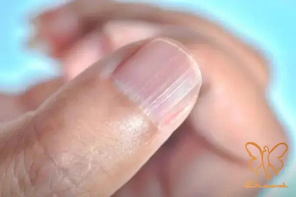 ناخن کبریتی ناخن کبریتی