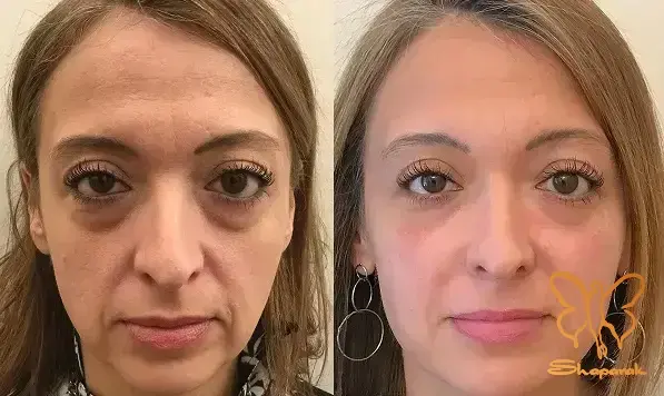 تزریق بوتاکس