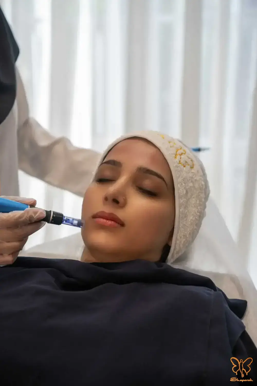 میکرونیدلینگ برای جای جوش در مشهد