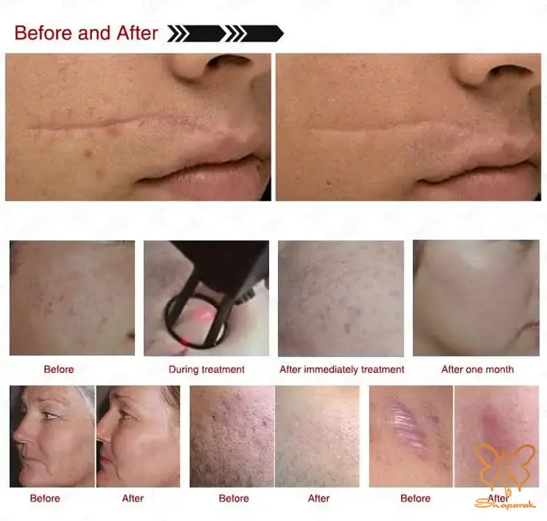 پوستی شفاف و صاف با آراف RF فرکشنال