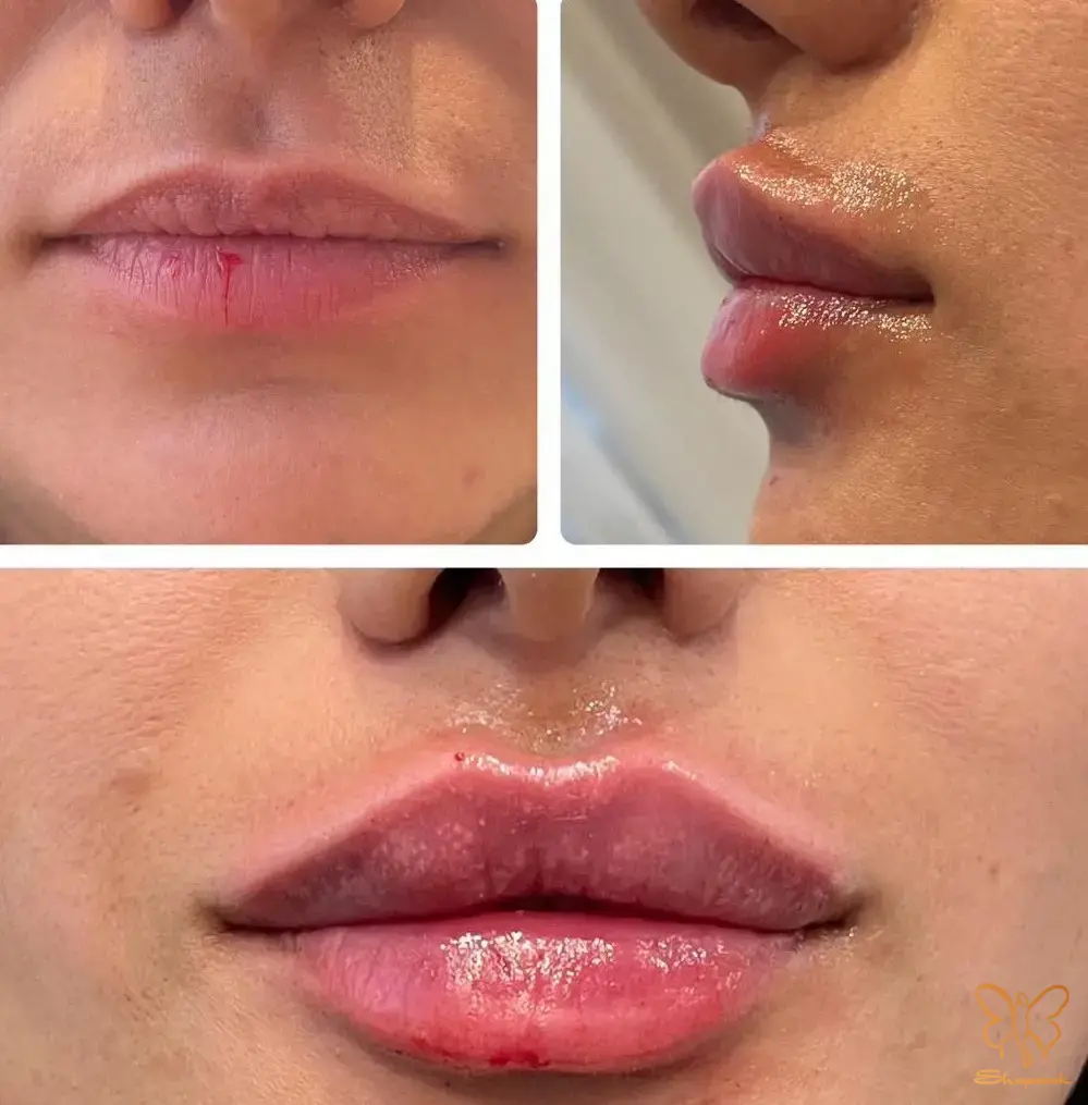 انتخاب مدل تزریق ژل لب در کلینیک شاپرک طلایی