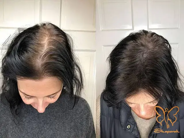  کلینیک تخصصی لیزر موهای زائد شاپرک طلایی مشهد