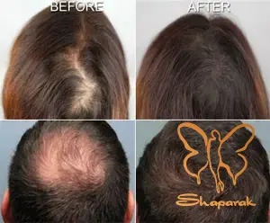  مزوتراپی پوست ومو مشهد