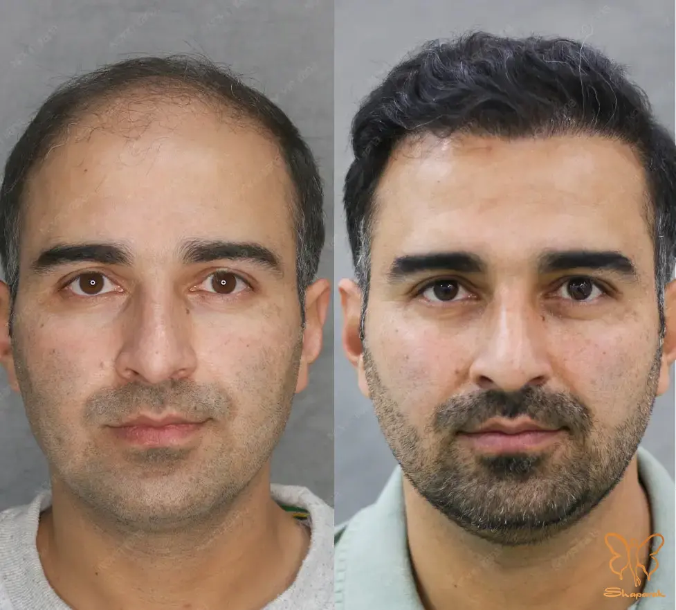 کلینیک تخصصی لیزر موهای زائد شاپرک طلایی مشهد کلینیک تخصصی لیزر موهای زائد شاپرک طلایی مشهد