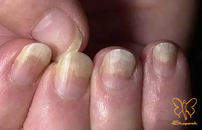 پسوریازیس ناخن پسوریازیس ناخن