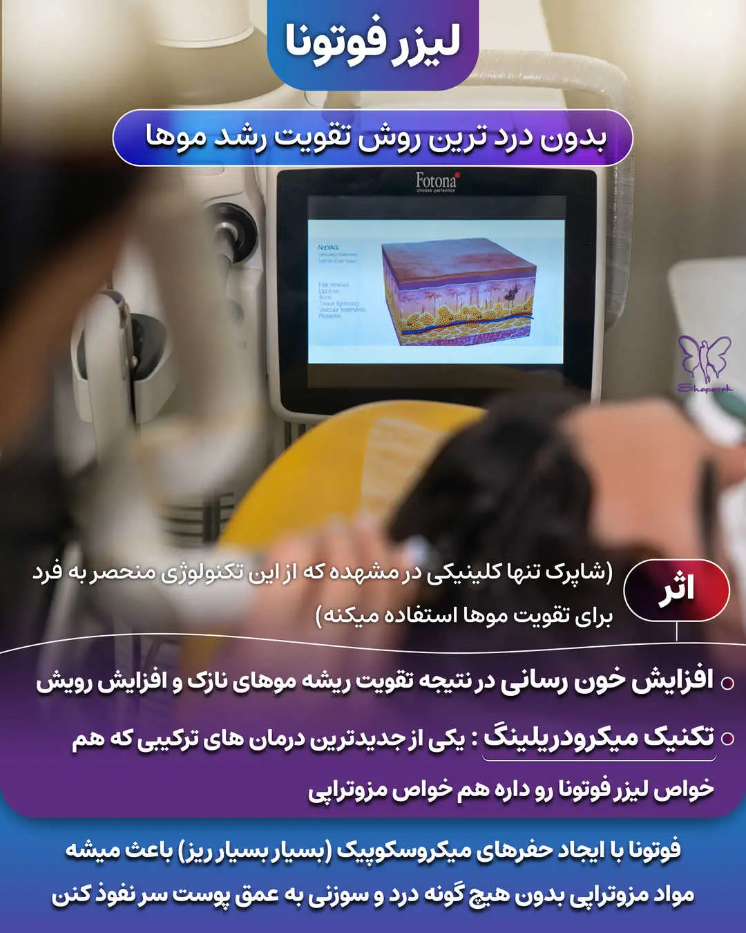 فوتونا میکرودرلینگ سر 