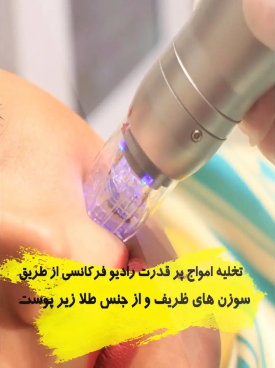 مزایای آر اف فرکشنال در کلینیک شاپرک طلایی