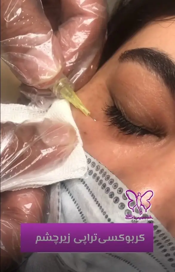 کربوکسیتراپی زیر چشم