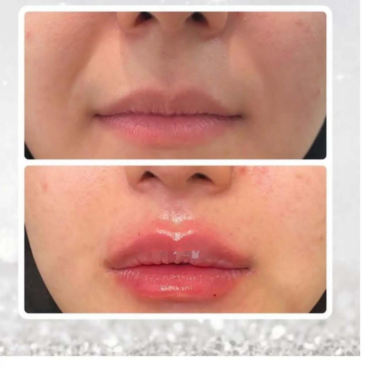 ژل ریوانس KISS Revanesse KISS طراحی شده برای لبهایی جوان و جذاب