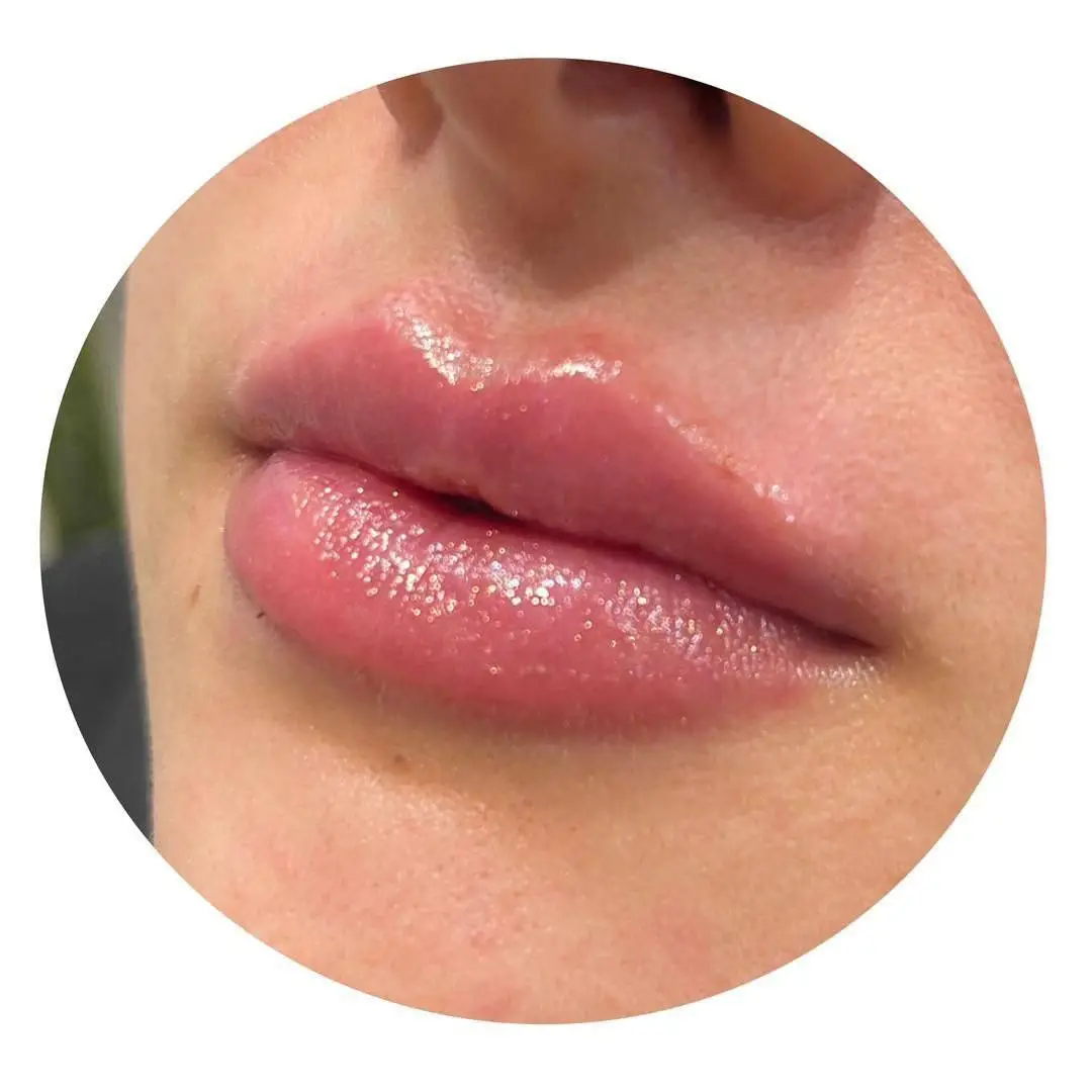 چه کسانی کاندیدای مناسبی برای تزریق ژل لب هستند چه کسانی کاندیدای مناسبی برای تزریق ژل لب هستند