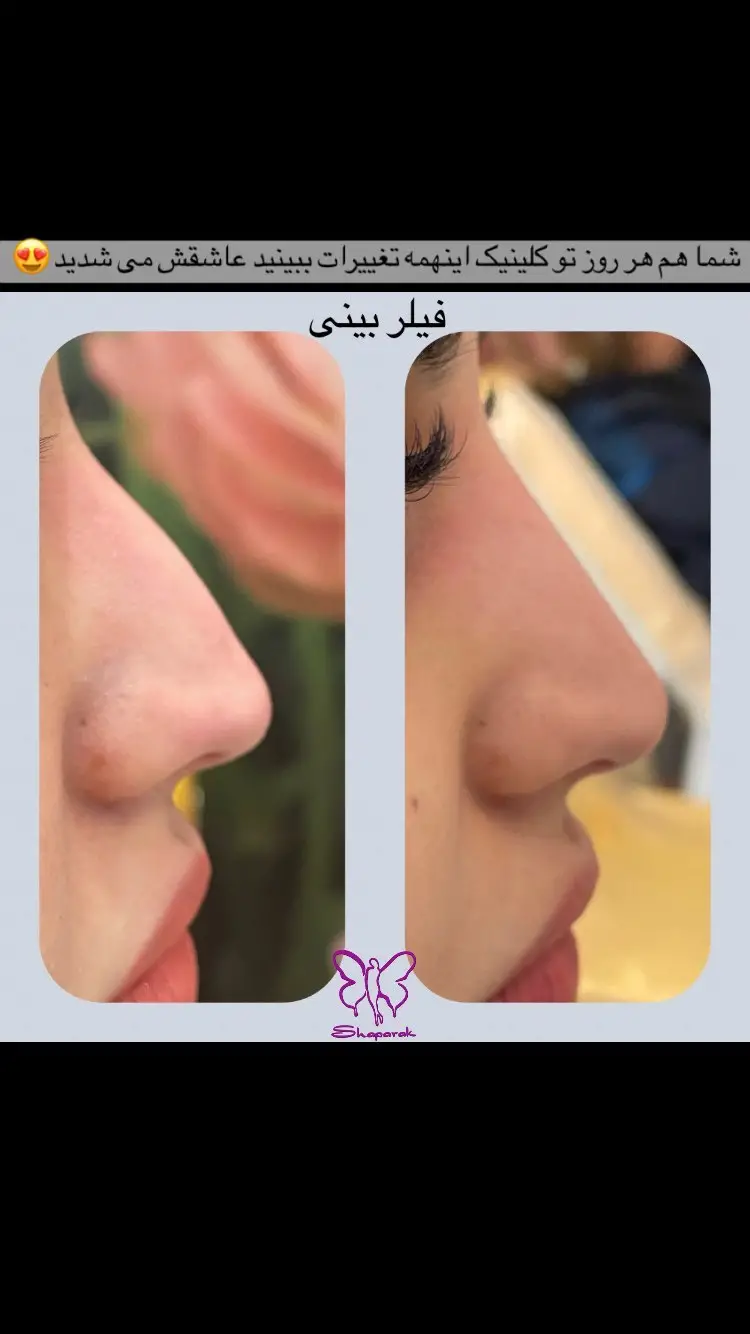 صاف کردن خطوط ریز روی پل بینی صاف کردن خطوط ریز روی پل بینی