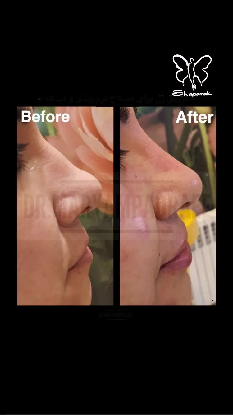 تزریق فیلر زیر چشم در مشهد تزریق فیلر زیر چشم در مشهد