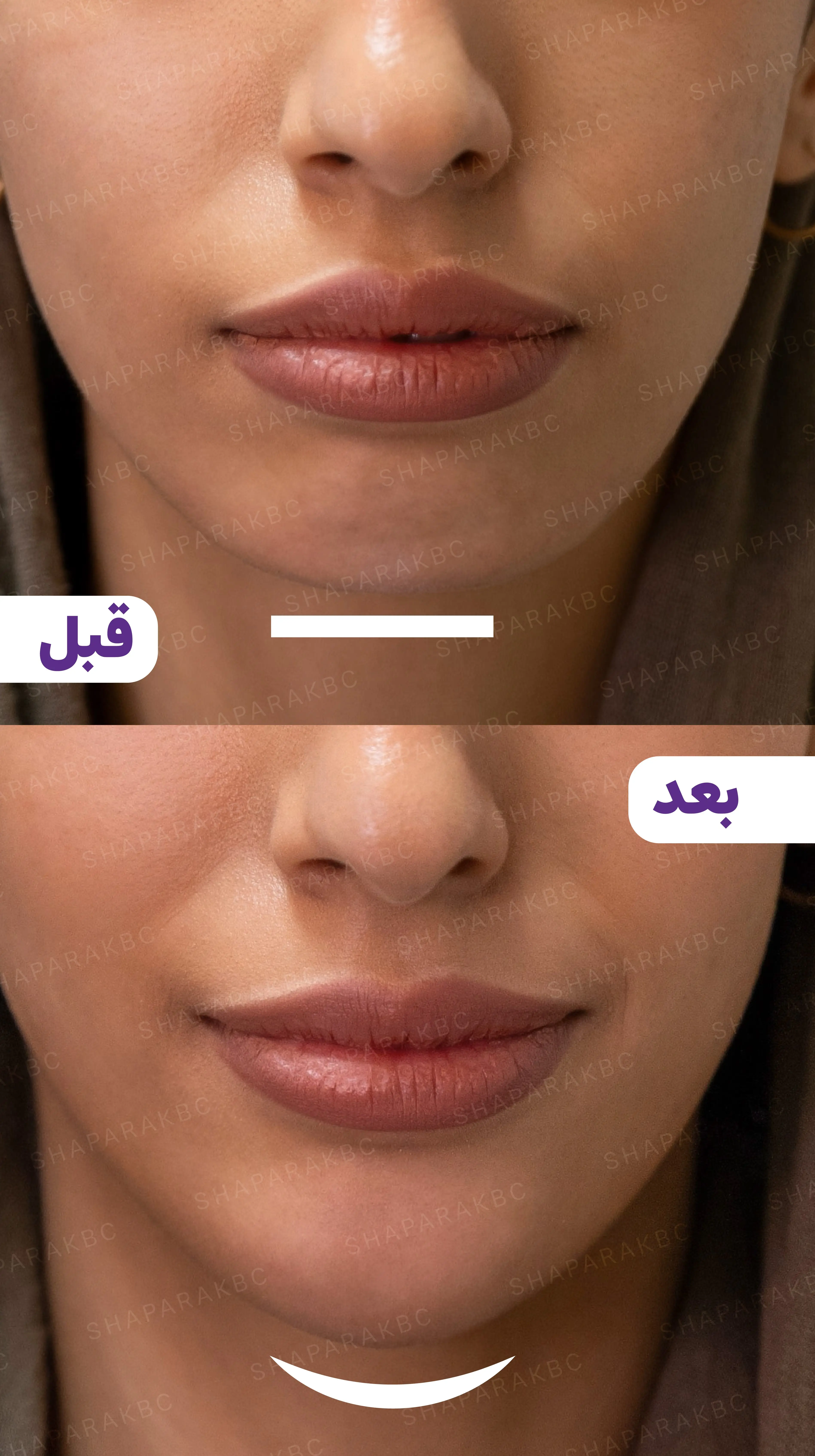 گرما و التهاب دشمنان ماندگاری فیلر گرما و التهاب دشمنان ماندگاری فیلر