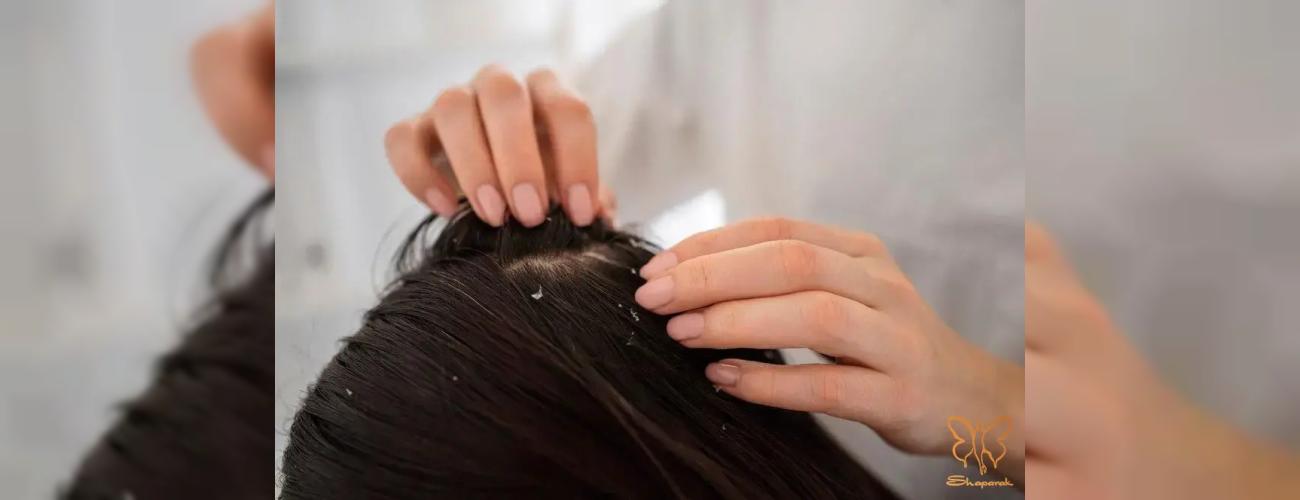 درماتیت سبورئیک (شوره سر و صورت): آیا می‌ توان بوتاکس، کاشت مو یا هایفو انجام داد؟