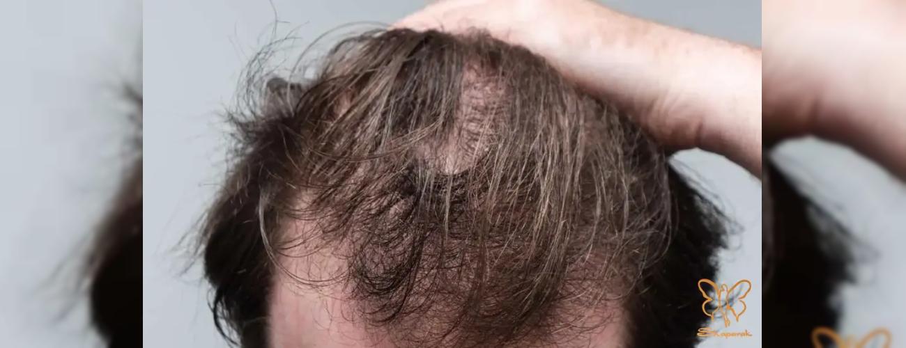 ریزش موی استرسی: تلوژن افلوویوم و درمان آن در کلینیک شاپرک مشهد