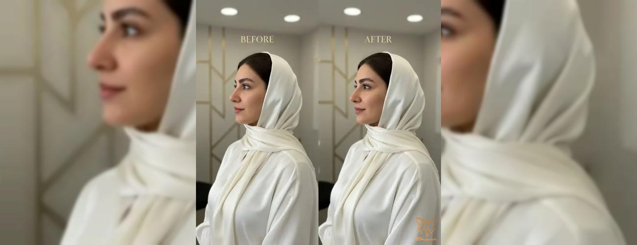 لیفت بینی با فیلر و بوتاکس: راز بینی خوش فرم در 15 دقیقه | کلینیک شاپرک طلایی مشهد