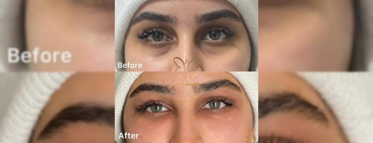 رفع گودی زیر چشم در کلینیک تخصصی شاپرک طلایی 