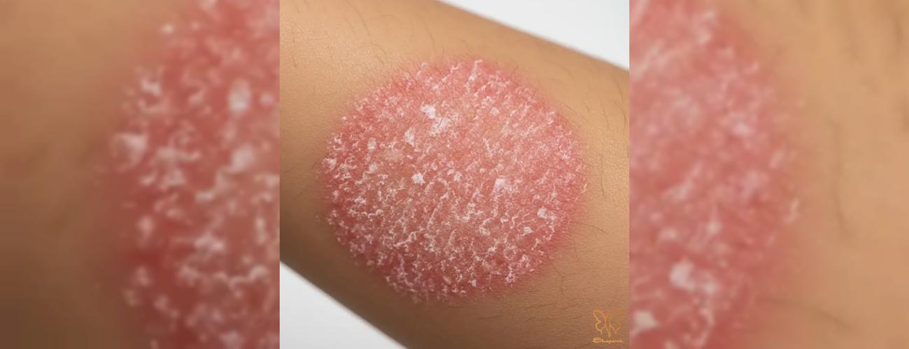 پوست شما خشک است یا اگزما دارید؟ [پاسخ پزشکان مشهد+ روش‌های درمانی جدید]