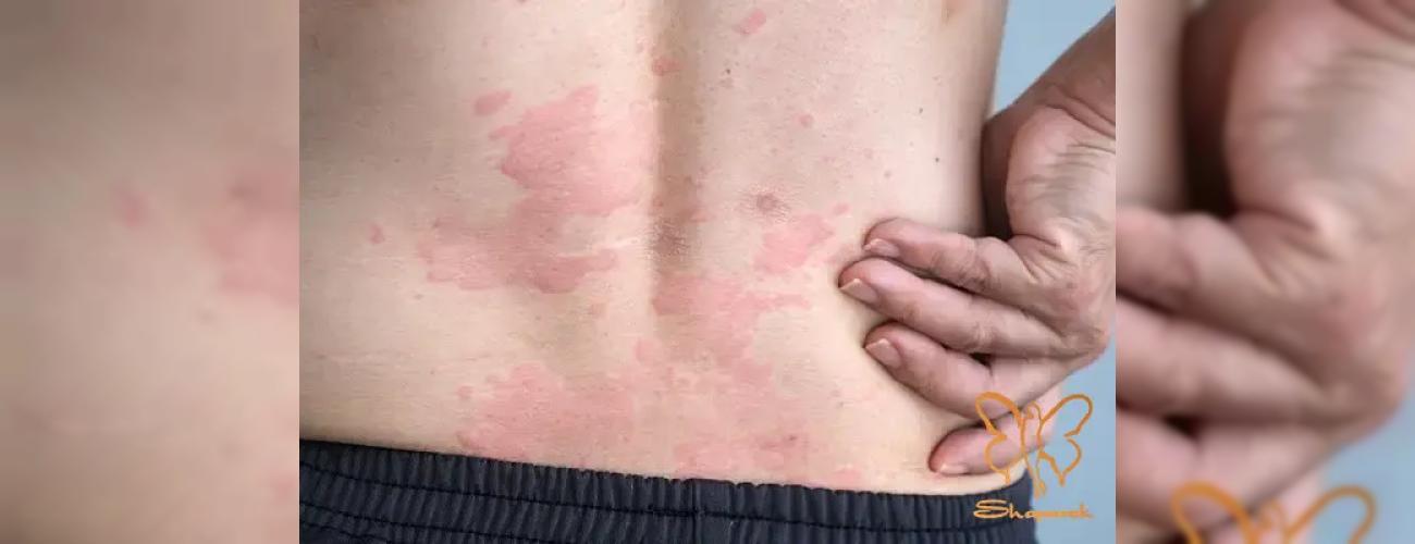 چرا بعد از لیزر بدنم کهیر می‌زند؟ راهکارهای طلایی کلینیک شاپرک مشهد