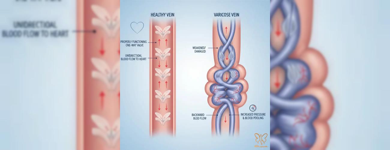 لیزر واریس پا: جدیدترین روش درمان در کلینیک شاپرک طلایی مشهد (بدون جراحی)