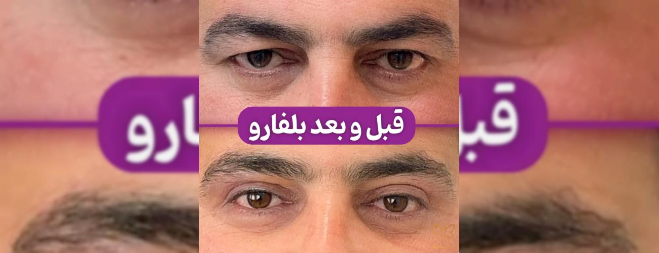 مراقبت‌های بعد از بلفاروپلاستی در مشهد | راهنمای کامل کلینیک شاپرک طلایی برای بهبودی سریع