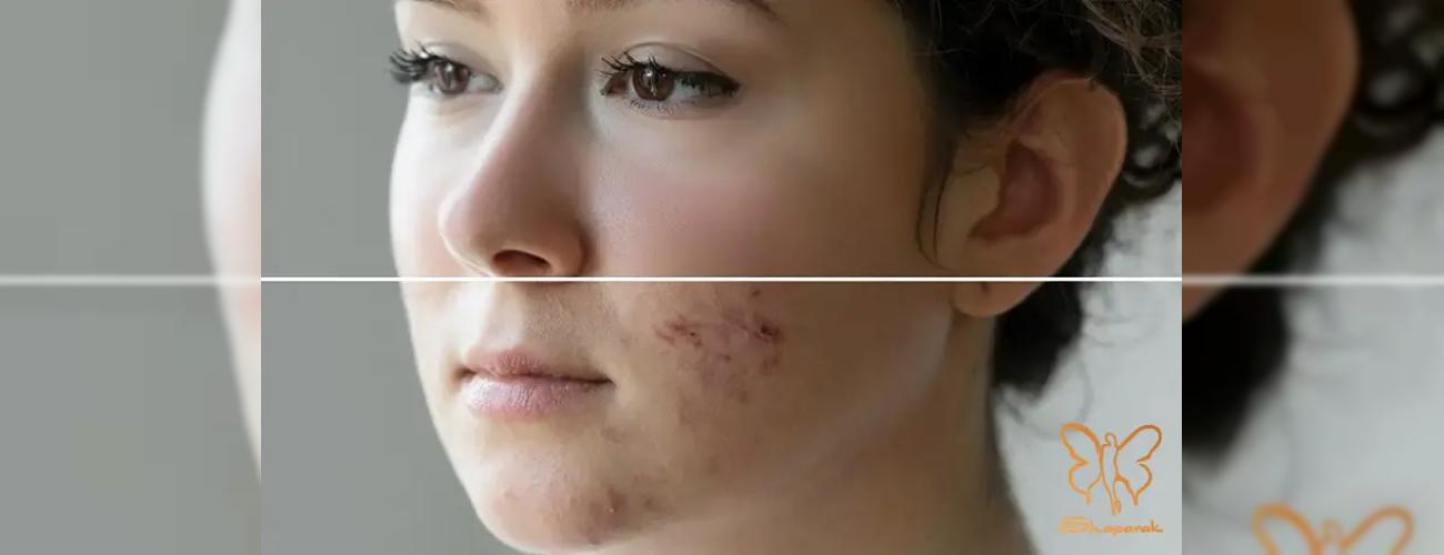 بررسی کامل بایدها و نبایدهای مصرف راکوتان و ایزوترتینوئین در کلینیک شاپرک مشهد