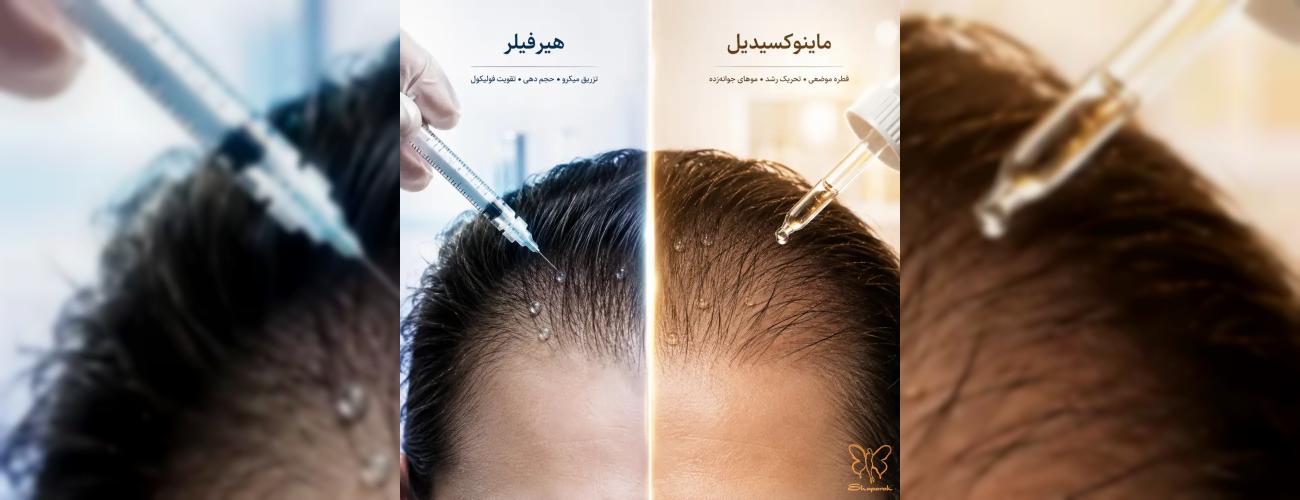 هیرفیلر یا ماینوکسیدیل؟ راهنمای قطعی درمان ریزش مو در مشهد + مقایسه کامل