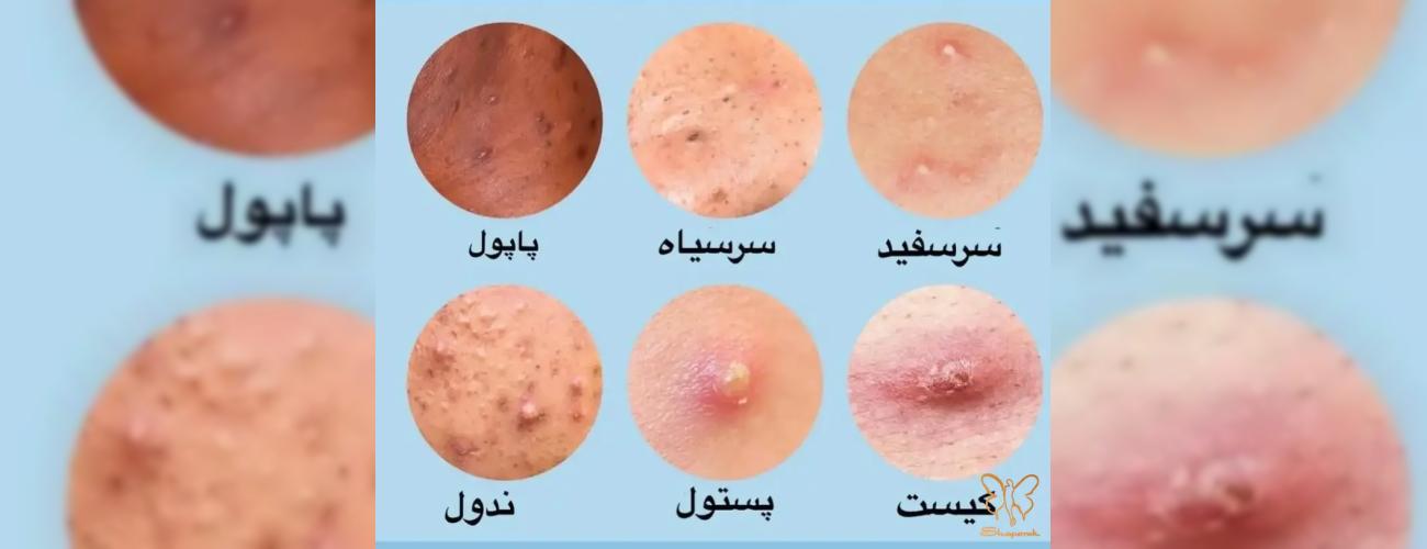 علت اصلی جوش‌های مزاحم باسن چیست؟ بهترین درمان‌های خانگی و کلینیکی در مشهد