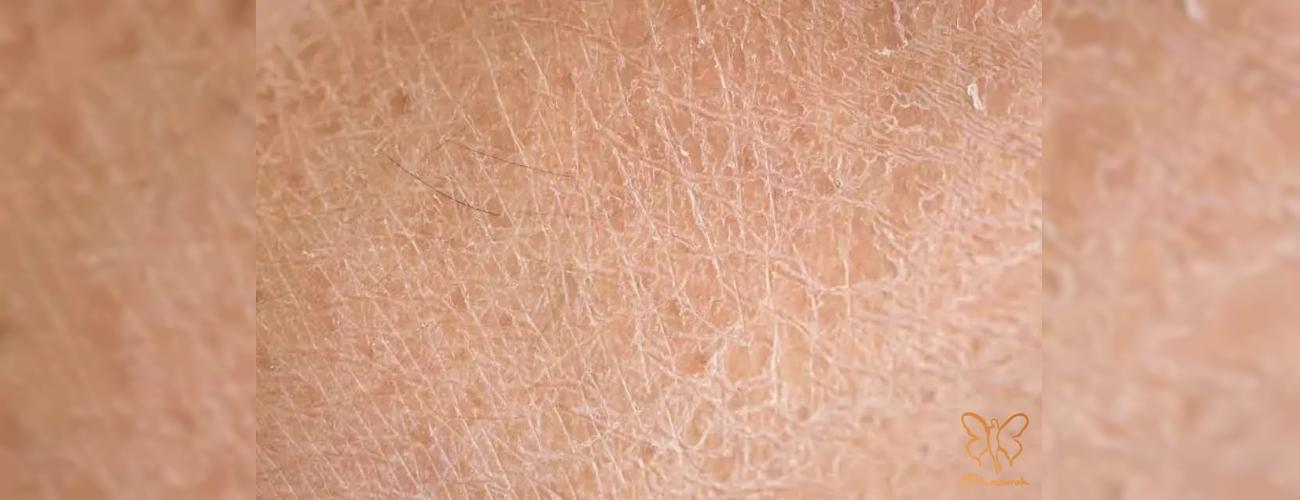 هایپرکراتوز: درمان قطعی ضخامت و زبری پوست در کلینیک شاپرک مشهد