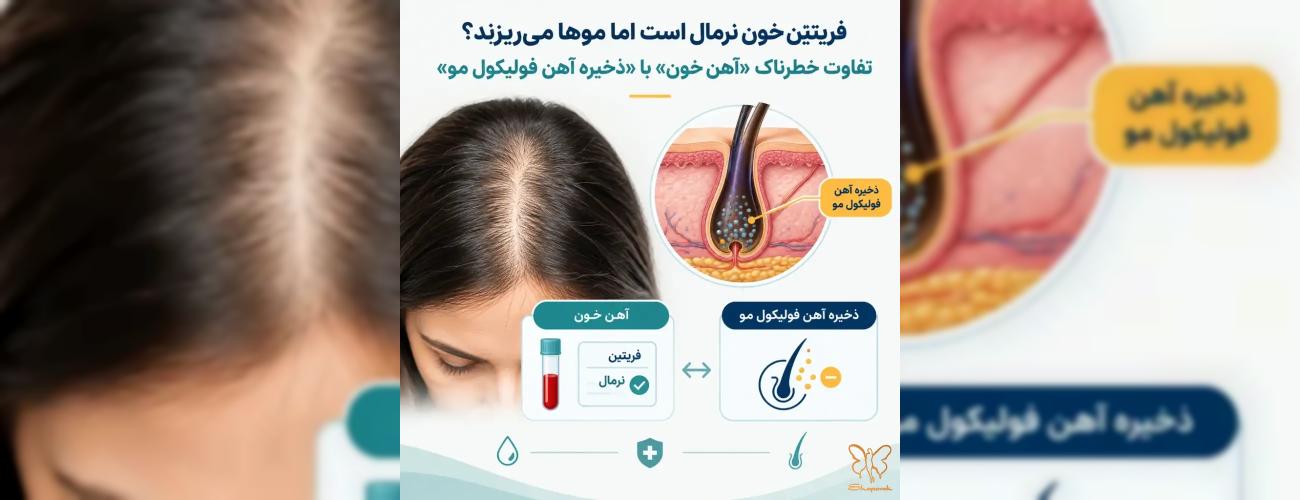 فریتین خون نرمال است اما موها می‌ریزند؟ تفاوت 