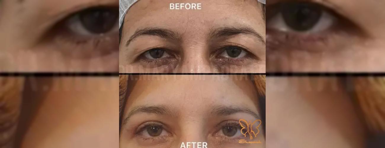 نگران خشکی چشم پس از جراحی پلک هستید؟ پیشگیری و درمان در کلینیک شاپرک طلایی