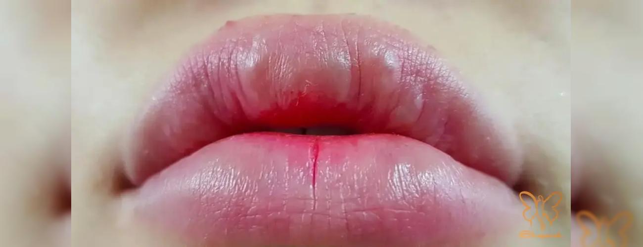 آیا گوله شدن فیلر زیر پوست خطرناک است؟ پاسخ قطعی پزشکان شاپرک طلایی مشهد