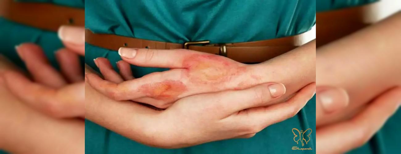 اسکلرودرمی و زیبایی: کدام خدمات (بوتاکس، ژل، لیزر) ممنوع و کدام مجاز است؟