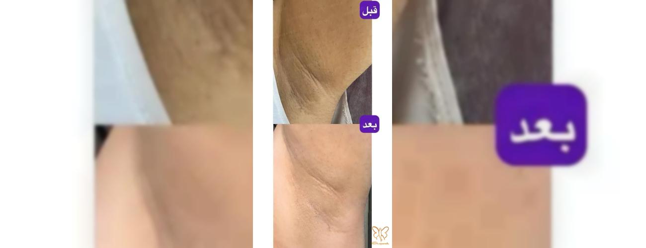 دیگر نگران تیرگی زیر بغل نباشید! با کربوکسی تراپی در کلینیک شاپرک طلایی، با اعتماد به نفس لباس بپوشید
