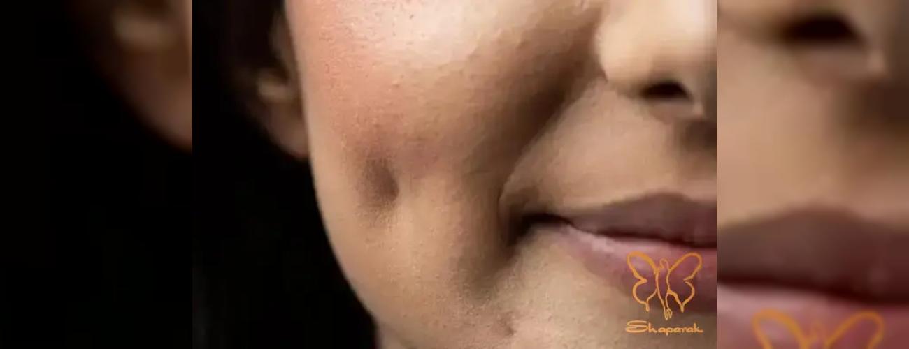 پشیمانی بعد از عمل چال گونه: از ظاهر مصنوعی تا عوارض دائمی + راه حل