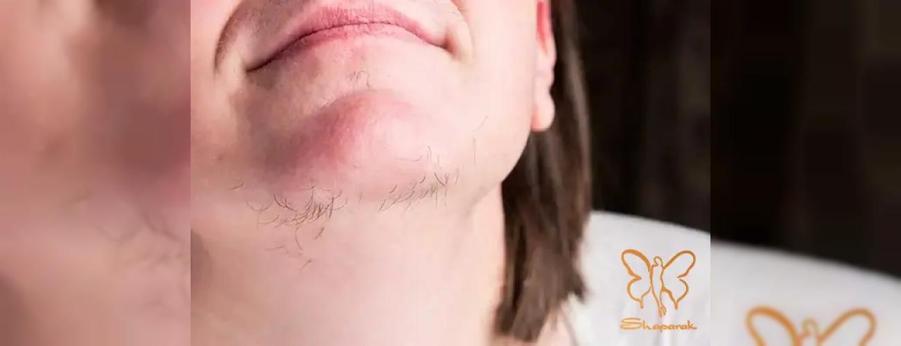 موهای زائد زیر چانه: از علت تا درمان قطعی با لیزر کندلا در مشهد | کلینیک شاپرک طلایی
