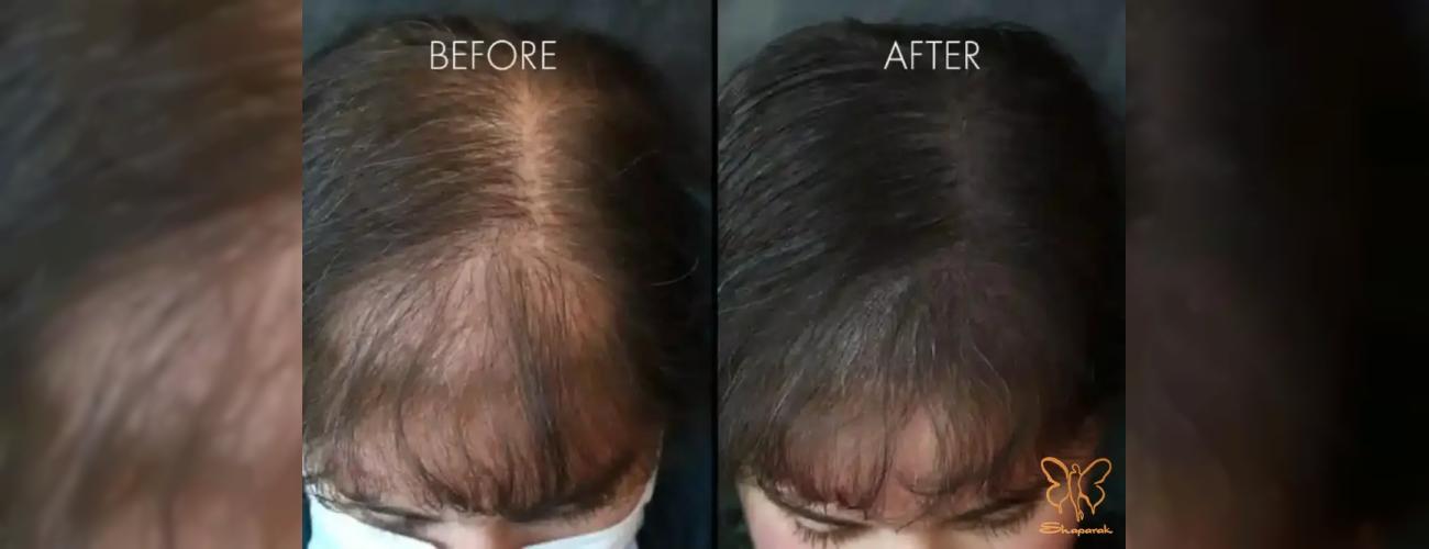  شامپو را بر اساس پوست سر انتخاب کنید، نه جنس مو {اسکالپ تراپی+محصولات نانوهیل}