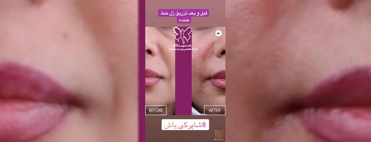 ژل ژوویدرم فرانسوی: زیبایی طبیعی با استاندارد طلایی اروپا در شاپرک طلایی مشهد