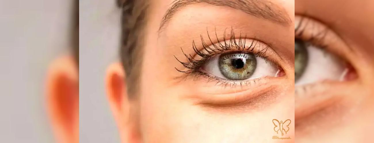 چرا زیر چشم‌ها پف می‌کند؟ ارتباط کمبود ویتامین و معجزه درمان در کلینیک شاپرک