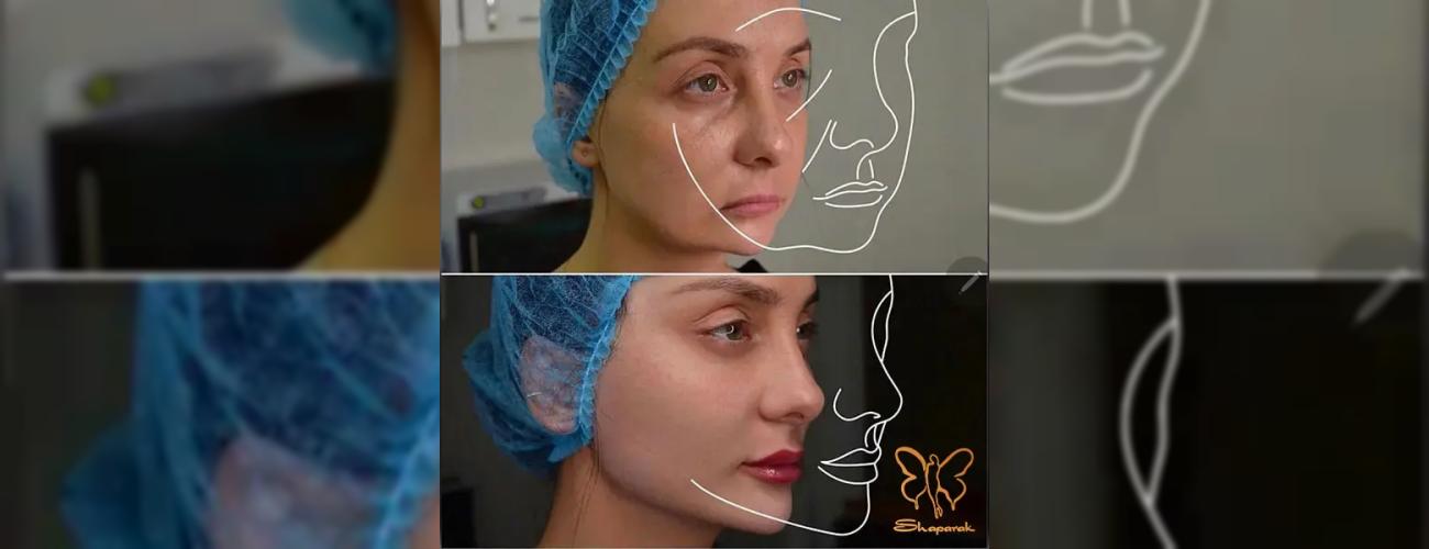 راهنمای جامع جوانسازی: تفاوت ژل، مزوژل و مزوتراپی در کلینیک شاپرک مشهد