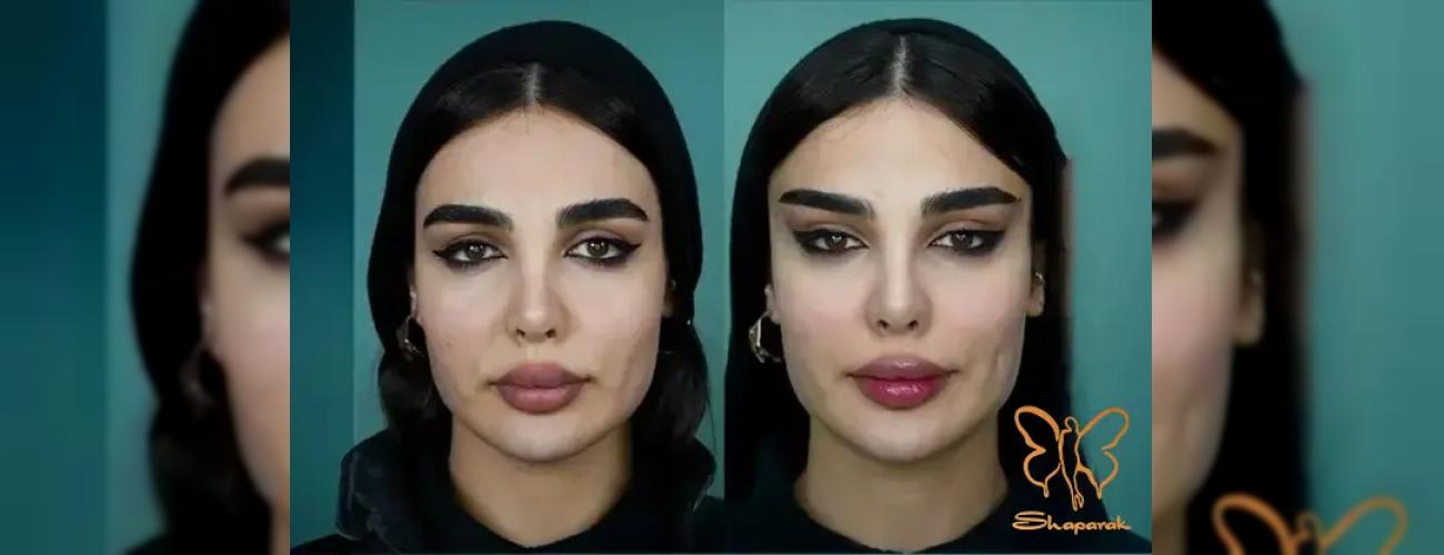 عوارض جراحی لیفت شقیقه: فقط شایعه است یا واقعیت دارد؟ | کلینیک شاپرک طلایی پاسخ می‌دهد