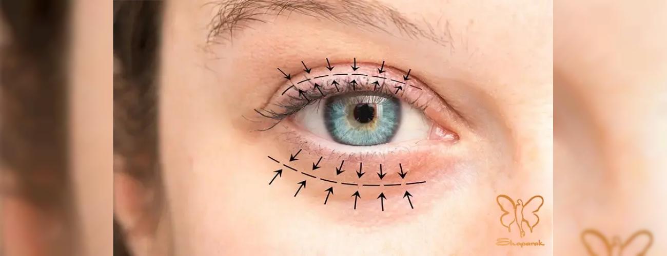 انواع بخیه در بلفاروپلاستی در مشهد: راز نتیجه طبیعی و بدون اسکار در شاپرک طلایی