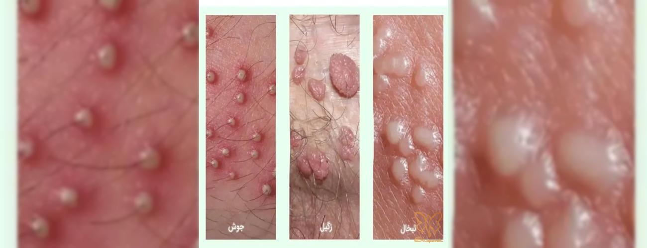 ویروس HPV و تبخال تناسلی: آیا لیزر باعث انتقال یا عود بیماری می‌شود؟