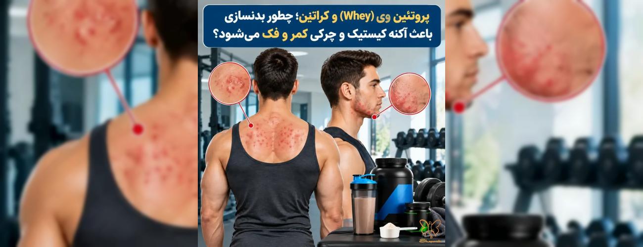 پروتئین وی (Whey) و کراتین، چطور بدنسازی باعث آکنه کیستیک و چرکی کمر و فک می‌شود؟